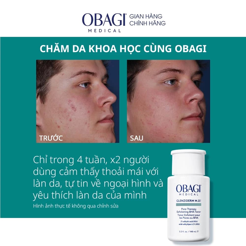 Toner tẩy tế bào chết, làm sạch mụn BHA Obagi Clenziderm M.D. Exfoliating 148ml